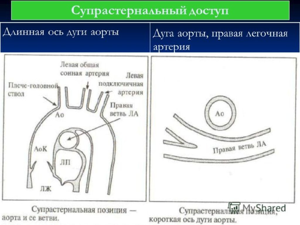 Длинная ось. Норма дуги аорты эхокардиография. Супрастернальная позиция в эхокардиографии. Супрастернальный доступ ЭХОКГ. Доступы при ультразвуковом исследовании сердца.