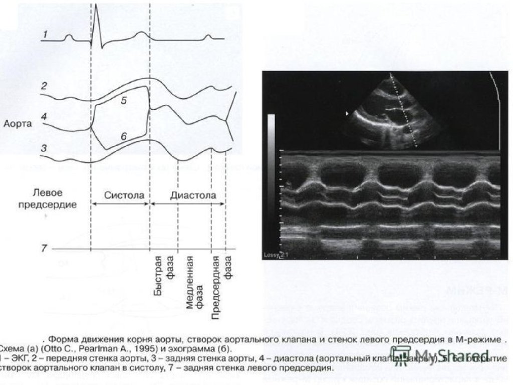 М режим. М режим аортального клапана при ЭХОКГ. М режим аортальный клапан. ЭХОКГ стеноз аортального клапана м режим. Измерение корня аорты на ЭХОКГ.