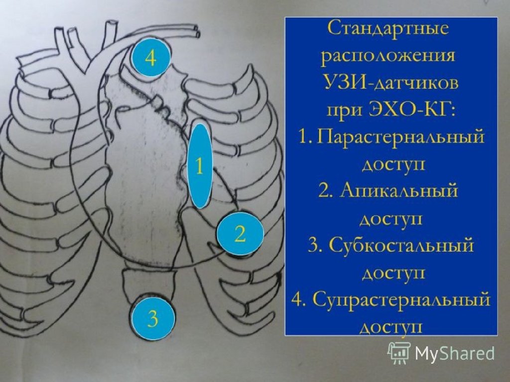 Сделай эхо. Позиции датчика при эхокардиографии. Доступы ЭХОКГ. Доступы при ЭХОКГ. Расположение датчика при эхокардиографии.