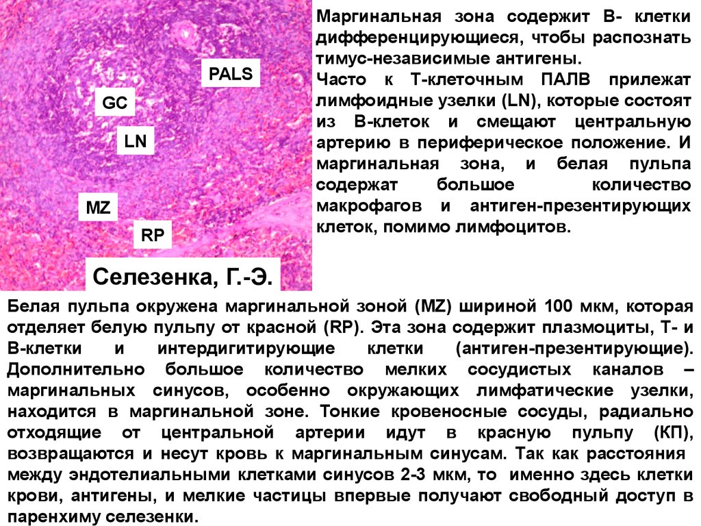 Лимфома клеток маргинальной зоны. Гиперплазия лимфоидной ткани селезёнки. В лимфоциты маргинальной зоны селезенки. Лимфома маргинальной зоны селезенки.