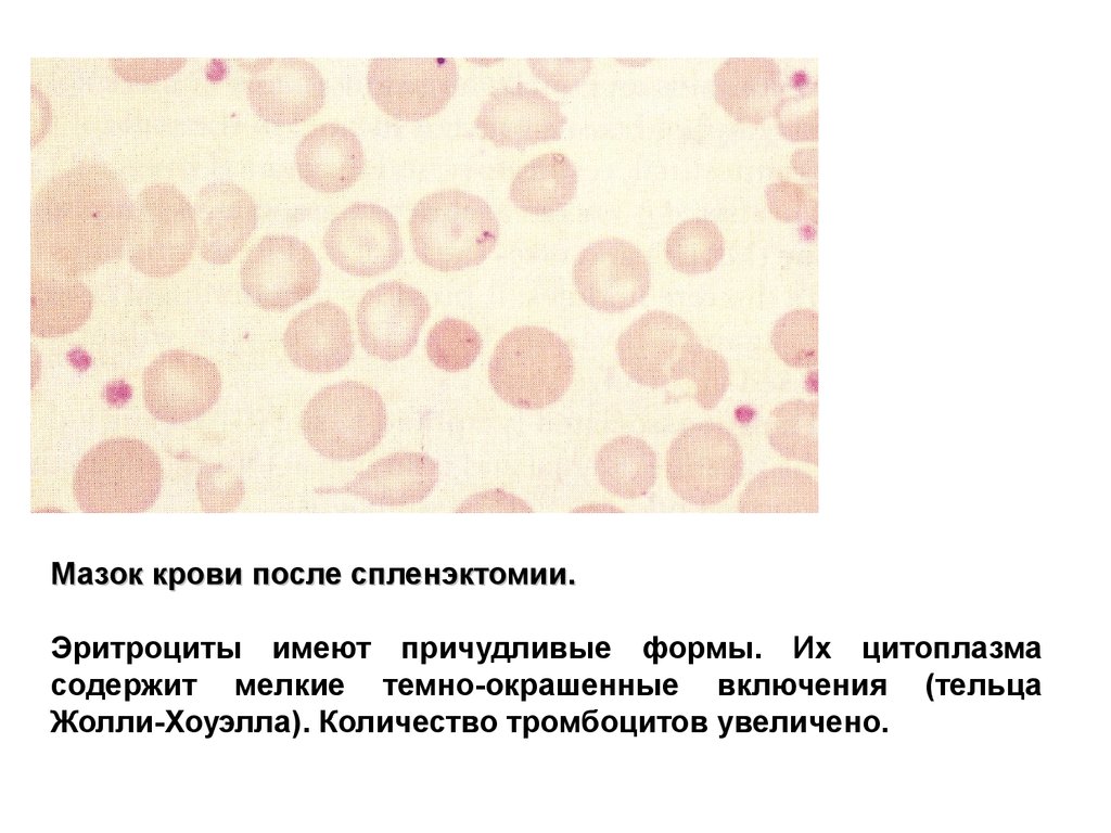 Тромбоциты в мазке. Тромбоцитопеническая пурпура мазок крови. Панцитопения мазок крови. Тромбоциты в мазке крови. Тромбоцитопения мазок.