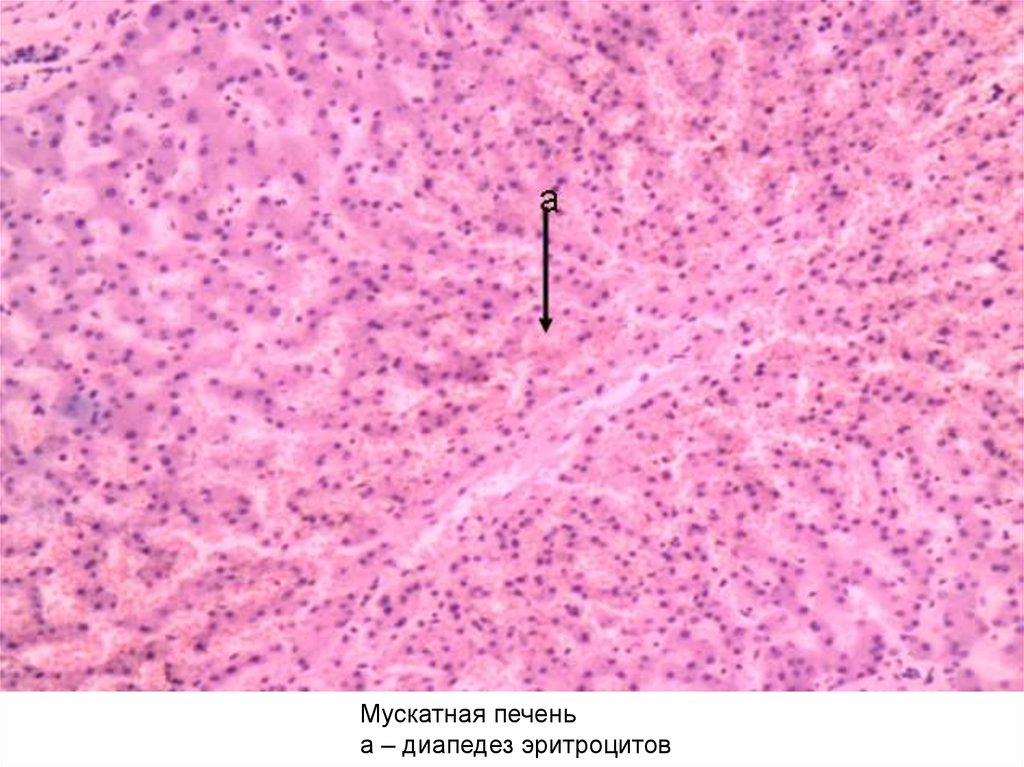 Хроническое венозное полнокровие печени микропрепарат рисунок
