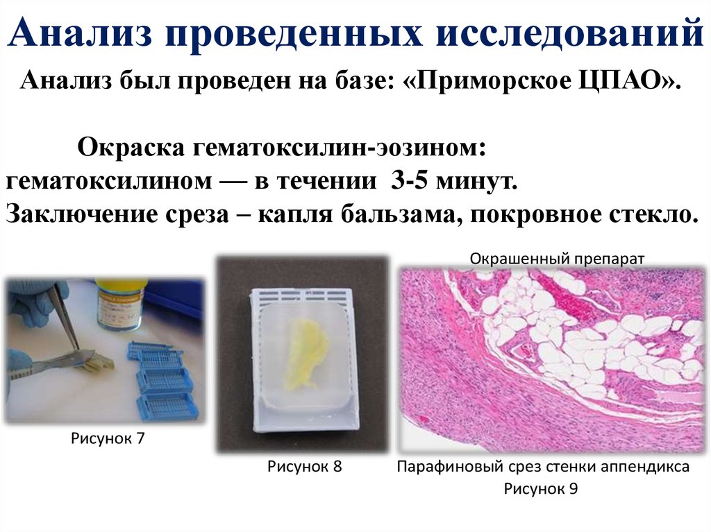 Особенности клинической картины острого аппендицита при тазовом расположении червеобразного отростка