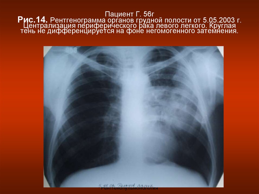 Периферический рак легкого. Рентгенография органов грудной полости. Негомогенные затемнения легких. Рентген грудной клетки затемнение. Периферическое образование левого легкого.