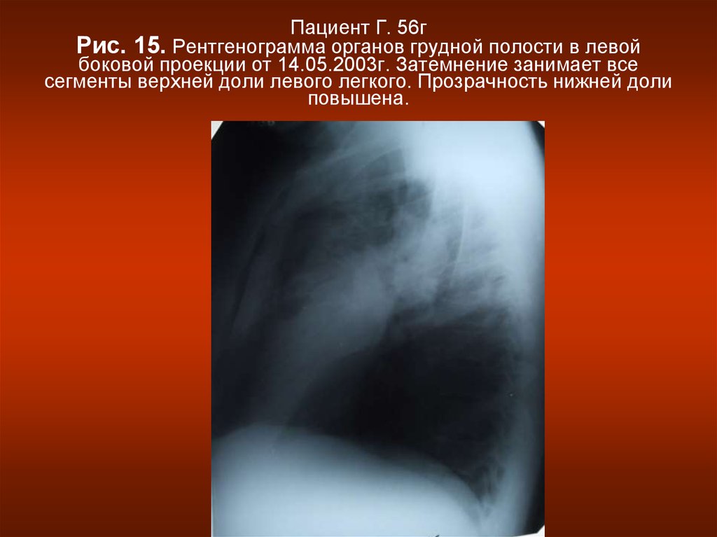 Рак легкого верхней доли. Затемнение верхней доли левого легкого. Затемнение нижней части легкого боковая проекция. Povisheni prozrachnost Verxni dolei liogkie. Повышены прозрачность верхних долей легких.