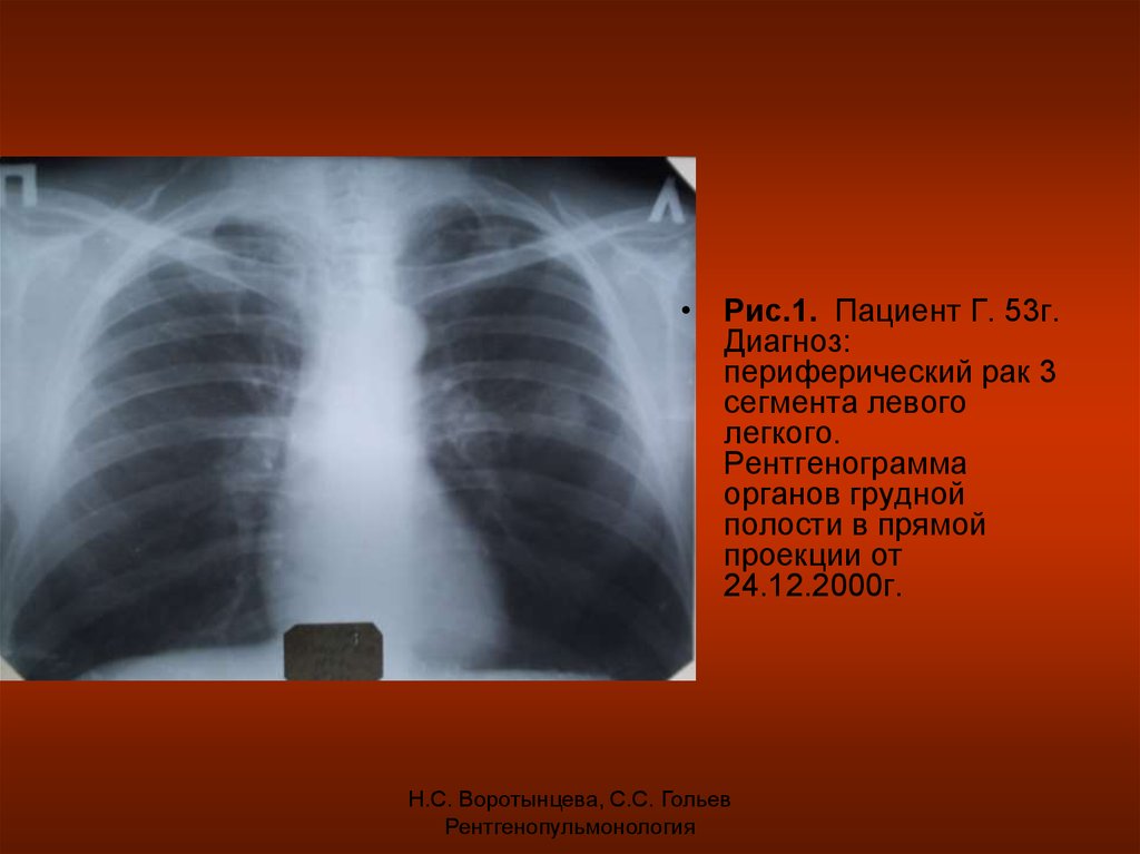 Диагноз г 5. Рентгенограмма органов грудной полости. Диагноз периферический 1г доли левого легкого.