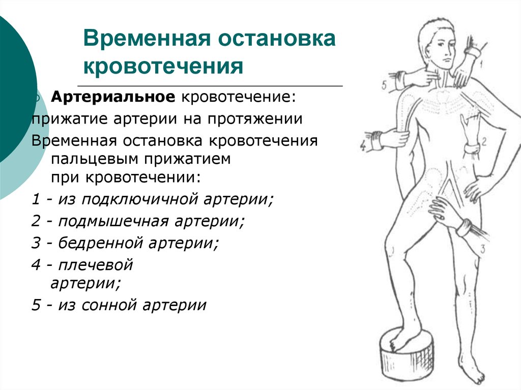 Признак эффективности пальцевого прижатия артерии