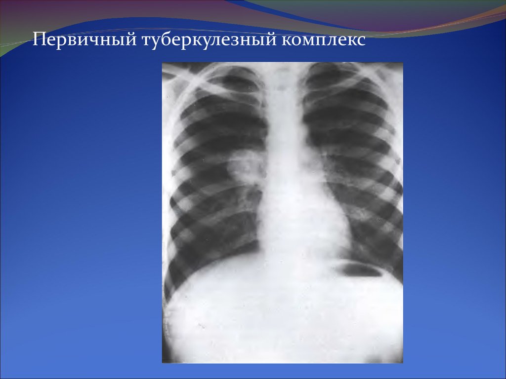 Первичный туберкулез. Пневмоническая фаза первичного туберкулезного комплекса. Первичный туберкулезный комплекс петрификация. Первичный туберкулезный комплекс в фазе кальцинации. Первичный туберкулезный комплекс рентгенография.