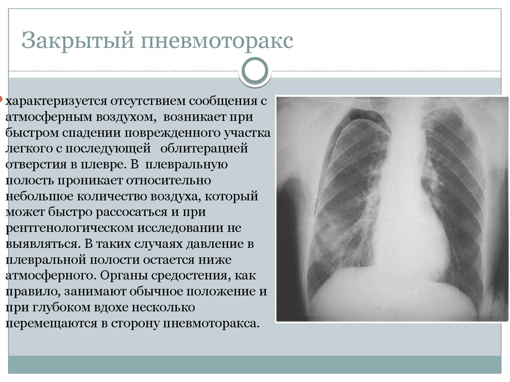 Физикальная картина при пневмотораксе характеризуется