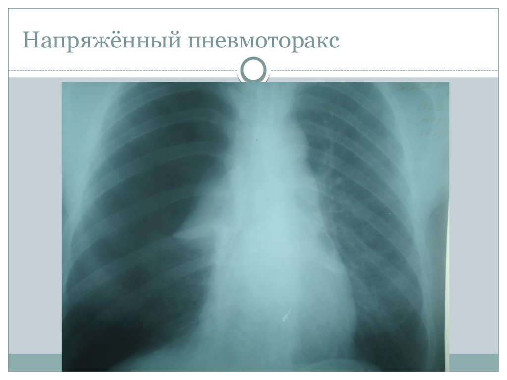 Напряженный пневмоторакс. Напряженный правосторонний пневмоторакс. Ренгтген напряжённый пневмоторакс. Открытый напряженный пневмоторакс. Клапанный пневмоторакс рентген.