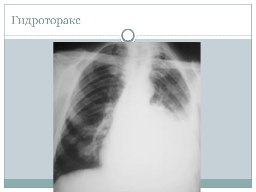 Лучевые признаки гидроторакса гемоторакса рентгеновская картина
