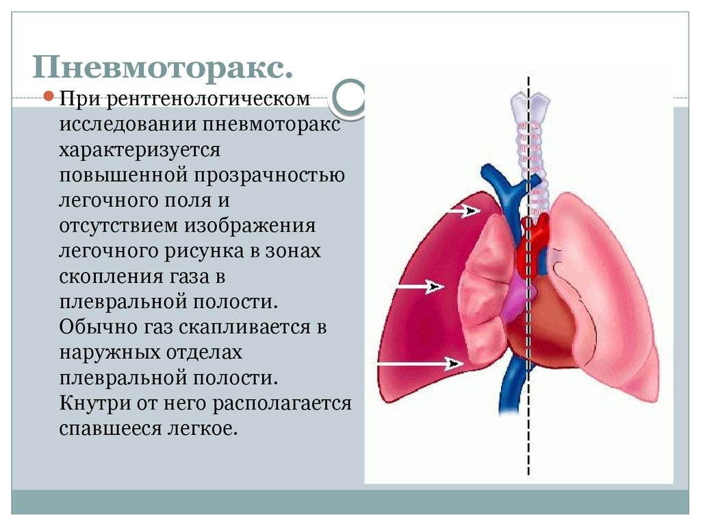 Спонтанный пневмоторакс презентация