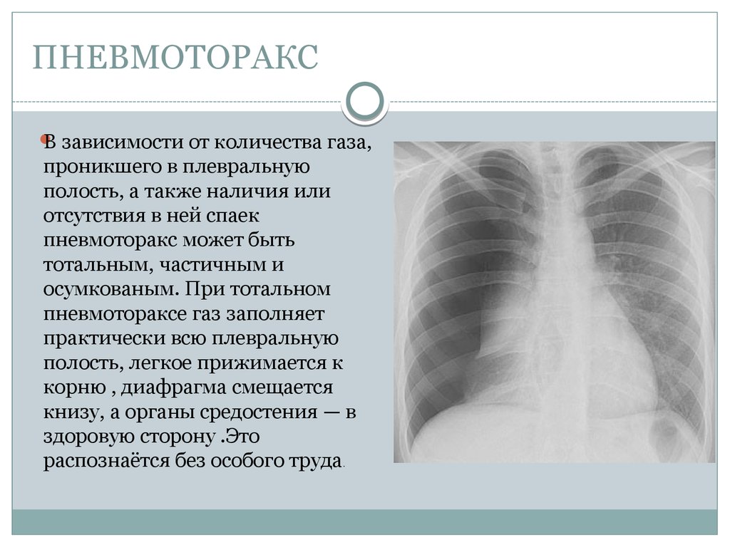 Пневмоторакс что это такое