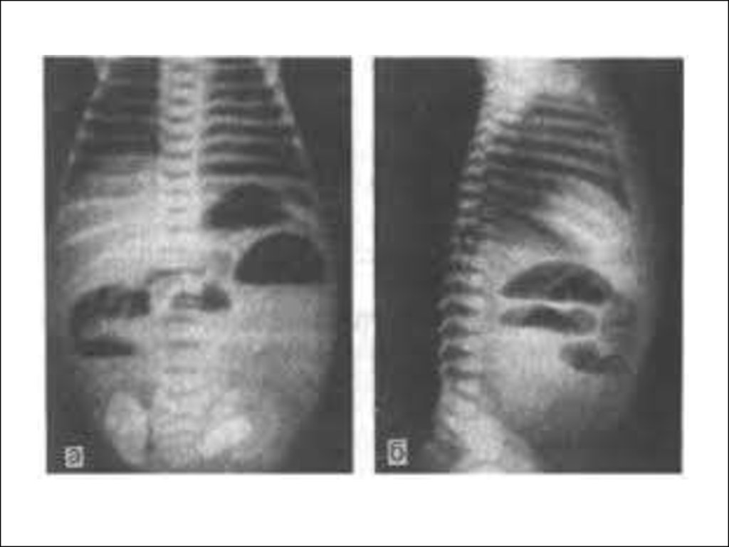Кишечная непроходимость рентген. Инвагинация кишечника рентгенография. Врожденная кишечная непроходимость рентген. Низкокишечная непроходимость рентген. Спаечная кишечная непроходимость рентген.