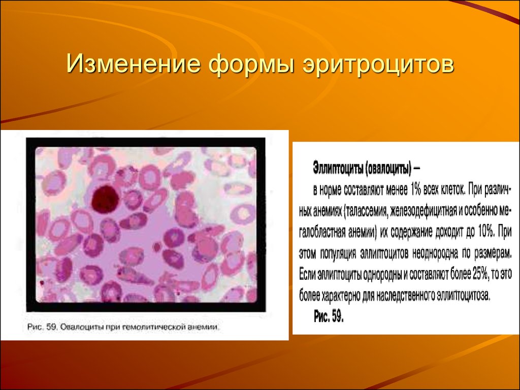 Форма эритроцитов. Апластическая анемия эритроциты. Апластическая анемия эритроциты форма. Железодефицитная анемия эритроциты форма. Эритроциты при апластической анемии.