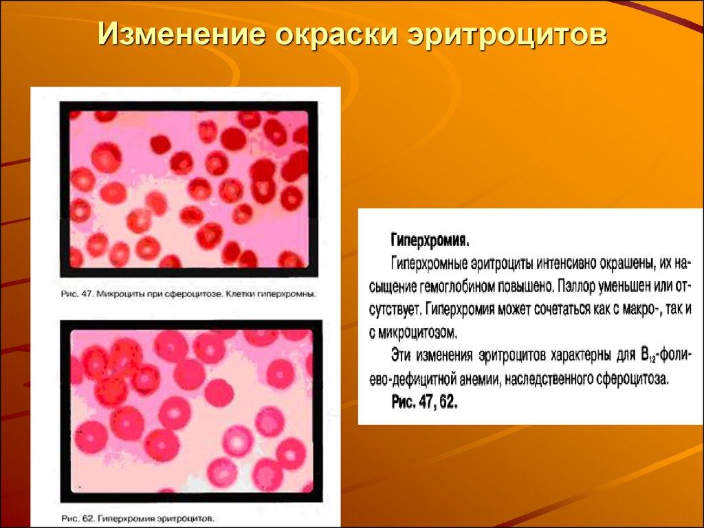 Клетки с гиперхромными ядрами. В12 анемия эритроциты гиперхромная. Мегаллобластная гиперхромная анемия. Изменение окраски эритроцитов при анемии. Гиперхромия макроцитоз.
