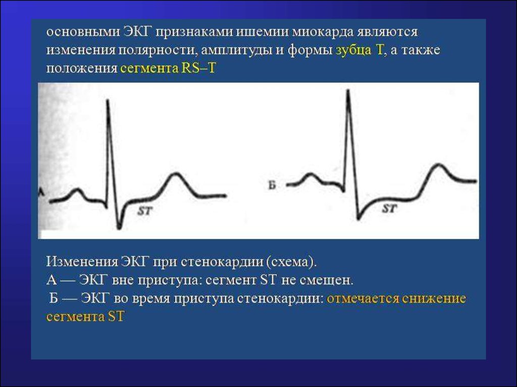 Изменение миокарда. ИБС стенокардия напряжения изменения на ЭКГ. Стабильная стенокардия ЭКГ признаки. ЭКГ при нестабильной стенокардии. Характерным изменением на ЭКГ при стенокардии напряжения.