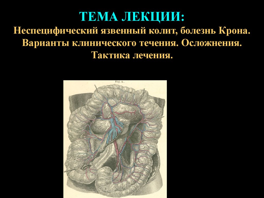 Болезнь лекция. Язвенный колит и болезнь крона. Неспецифический язвенный колит лекция. Няк этиология. Неспецифический язвенный колит патогенез.