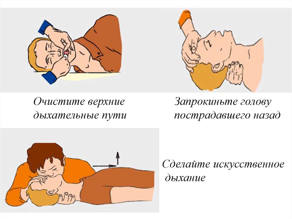 Виды искусственного дыхания. Сон делал искусственное дыхание. Порядок искусственного дыхания при утоплении. Сон делал искусственное дыхание. Сон делал искусственное дыхание.