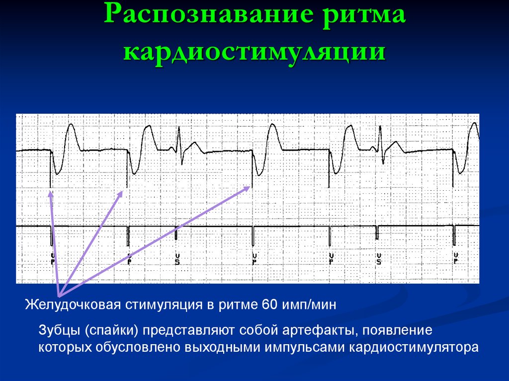 Экг с кардиостимулятором картинки