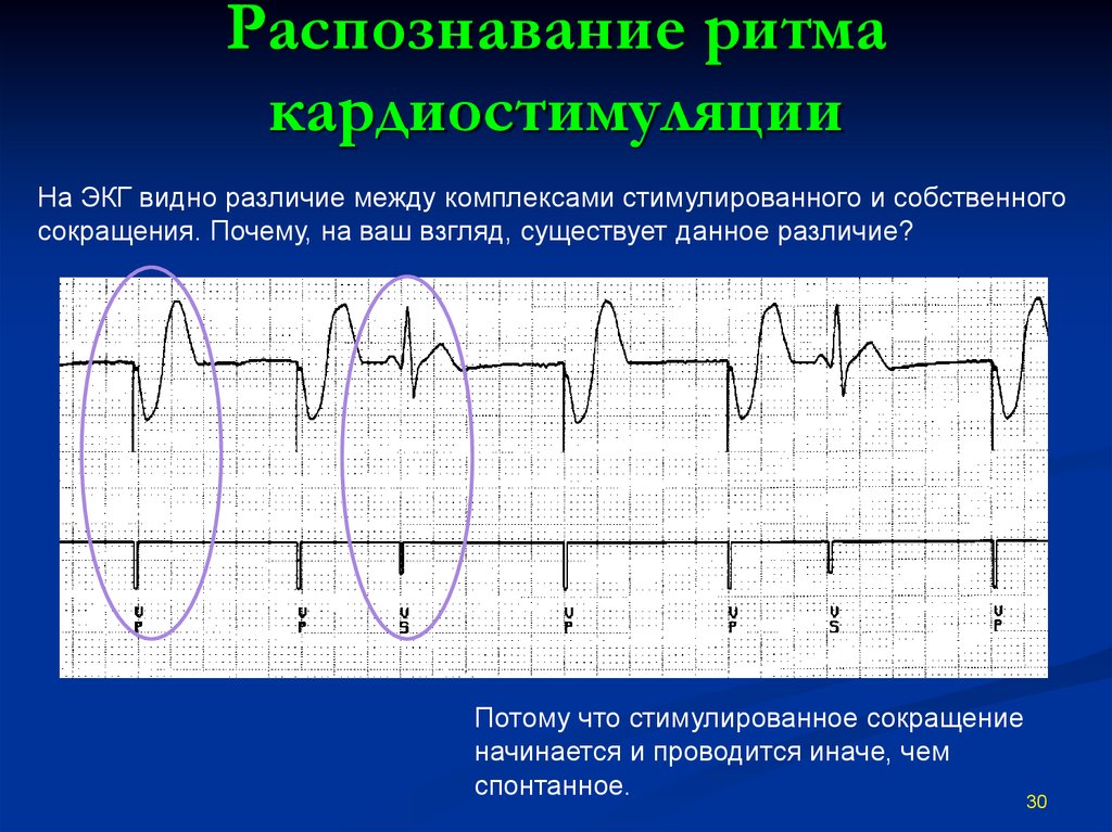 Экг с кардиостимулятором картинки