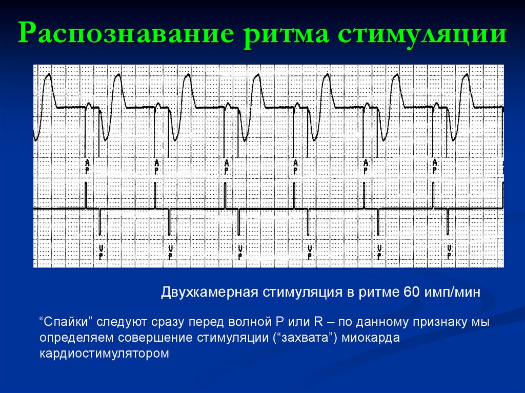 Экг с кардиостимулятором картинки