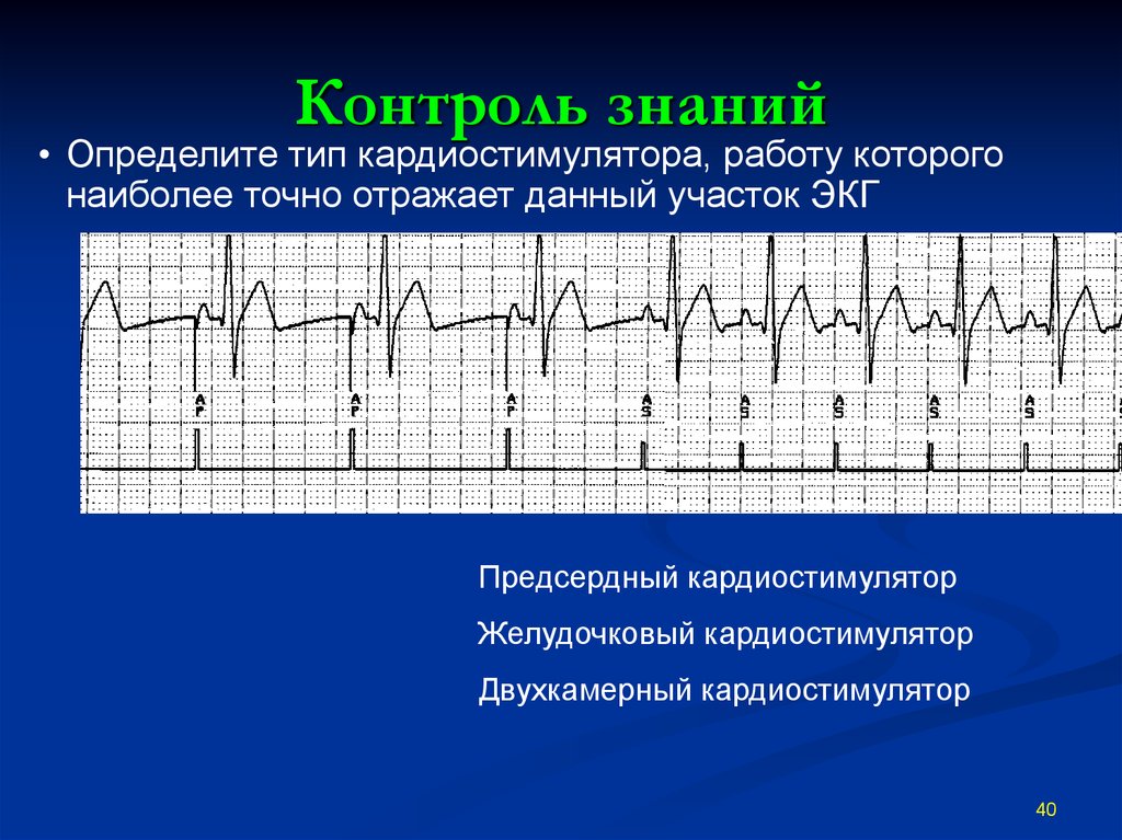 При наличии кардиостимулятора можно. Желудочковая стимуляция экс ЭКГ. Ритм двухкамерного кардиостимулятора на ЭКГ. Ритм на ЭКГ при кардиостимуляторе. Описание ЭКГ при кардиостимуляторе.