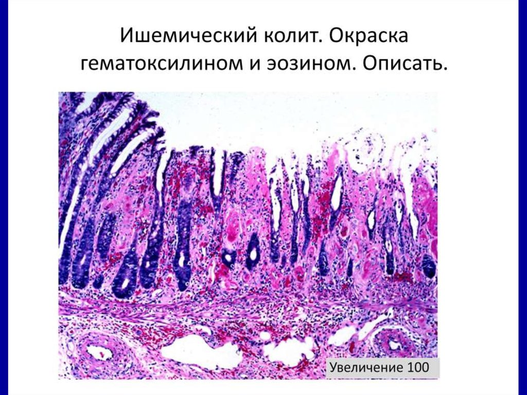 Ишемический колит формы.