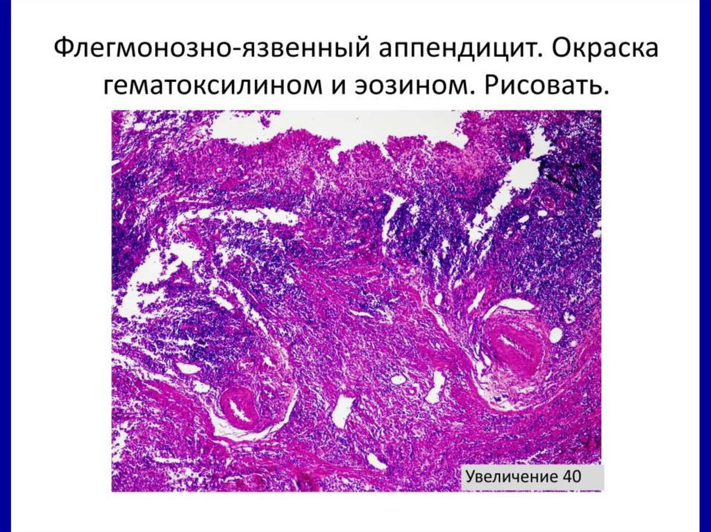 Ишемическая болезнь кишечника. Ишемическое поражение кишечника что это.