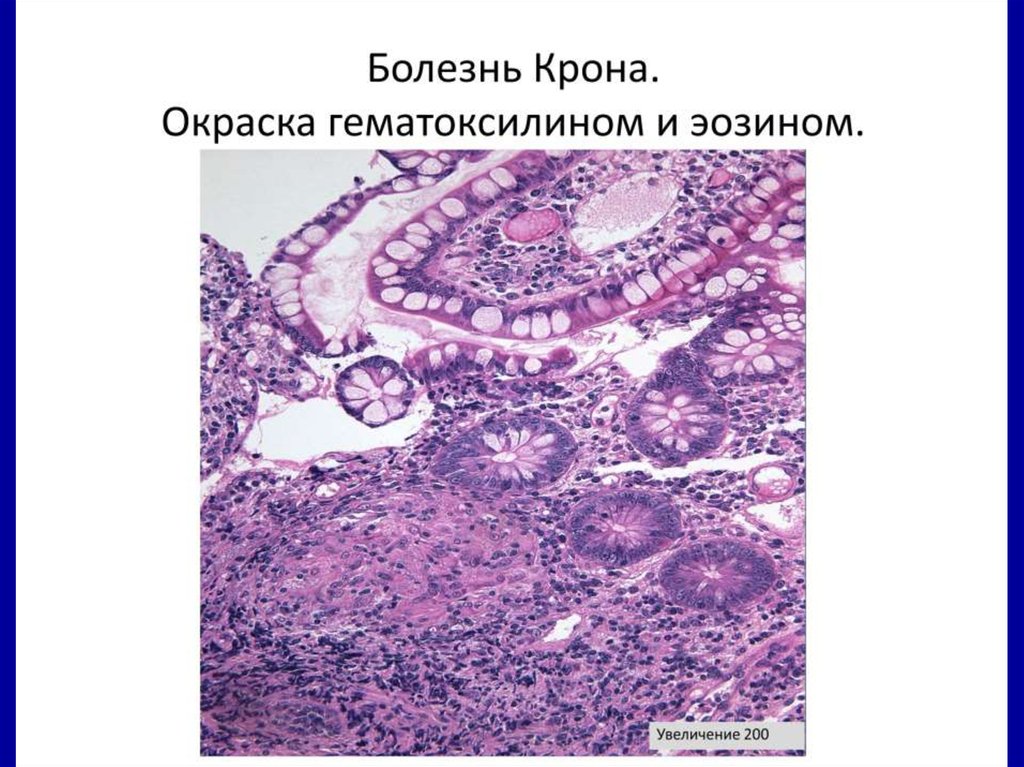 Заболевания кишечника презентация. Межворсинчатый тромбоз гистология. Тромбоз межворсинчатого пространства гистология.