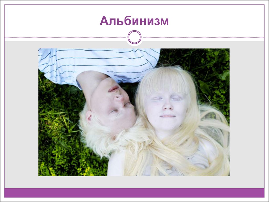 Альбинизмом страдают. Альбинизм генная мутация. Альбинизм хромосомная мутация. Генетические заболевания альбинизм.