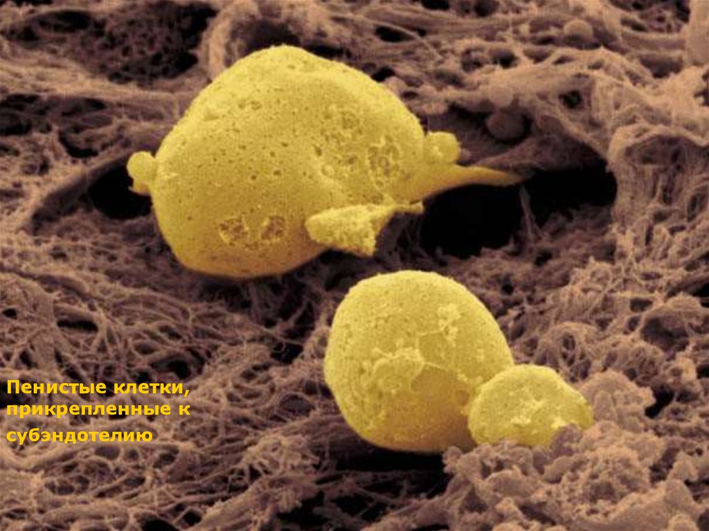 Пенистое содержимое. Пенистые клетки и ксантомные клетки. Макрофаги пенистые клетки. Пенистые клетки атеросклероз.
