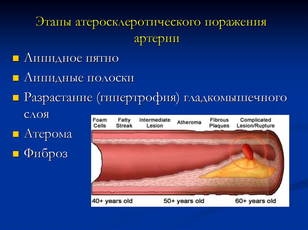 Атеросклеротическое поражение. Атеросклеротическое поражение артерий. Локализация атеросклеротической язвы. Этапы развития атеросклеротических поражений. Атеросклеротические пятна.