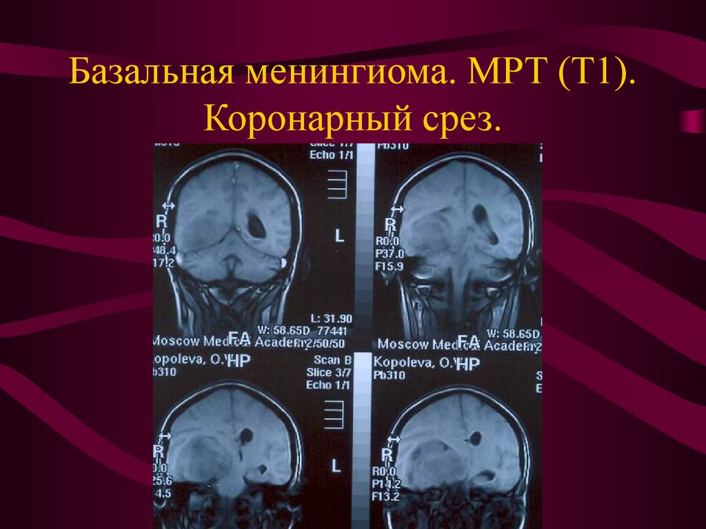 Опухоль мозга презентация