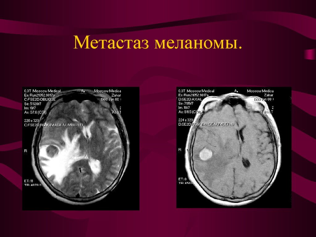 Меланома метастазы в мозг