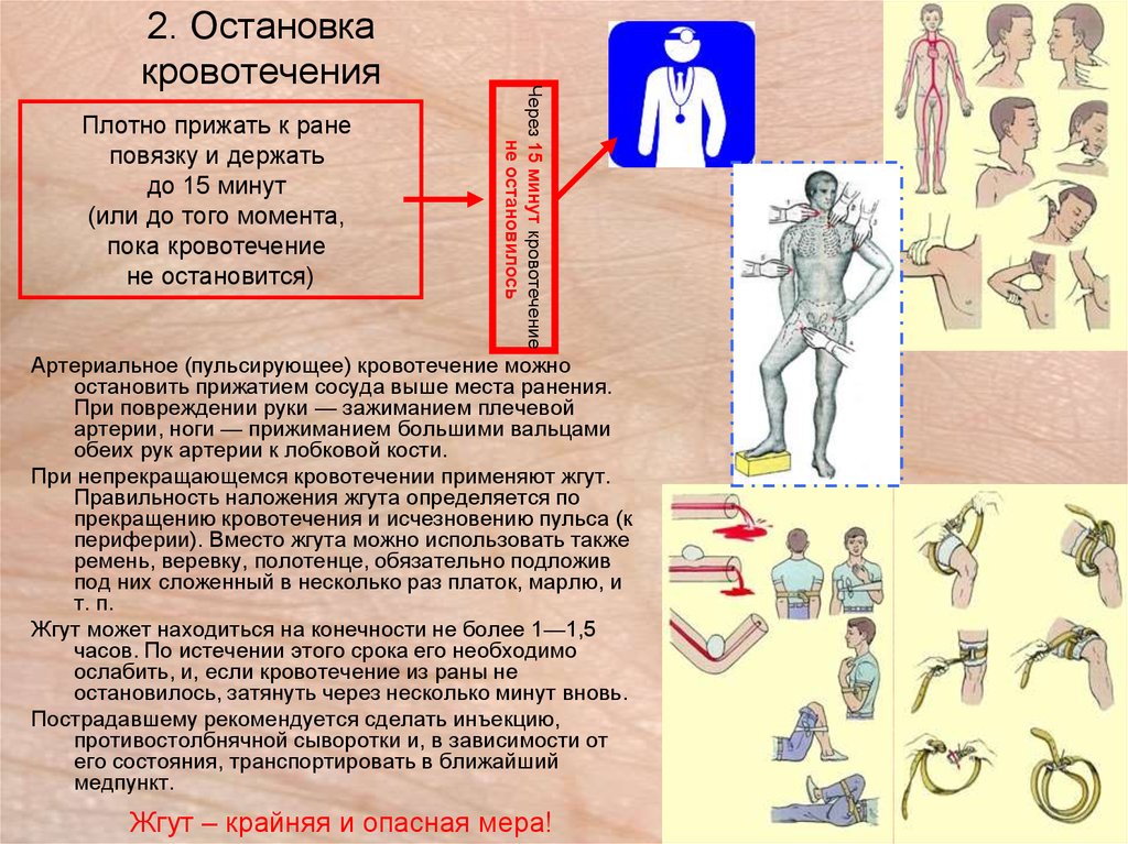 Наложение жгута при травматической ампутации. Памятка остановка кровотечения. Схема остановки кровотечения. Памятка способы остановки кровотечений. Для остановки кровотечения необходимо.