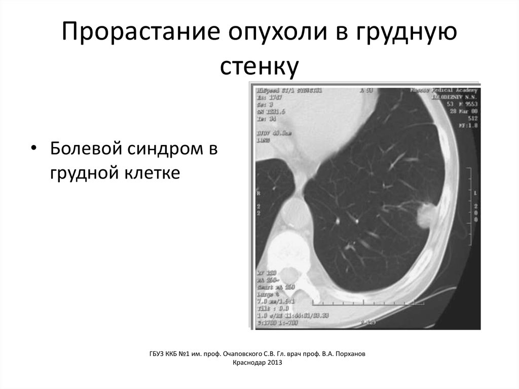 Грудной рак. Опухоли грудной стенки. Опухоль грудной клетки. Опулодь грудной клетки. Новообразование на грудной клетке.