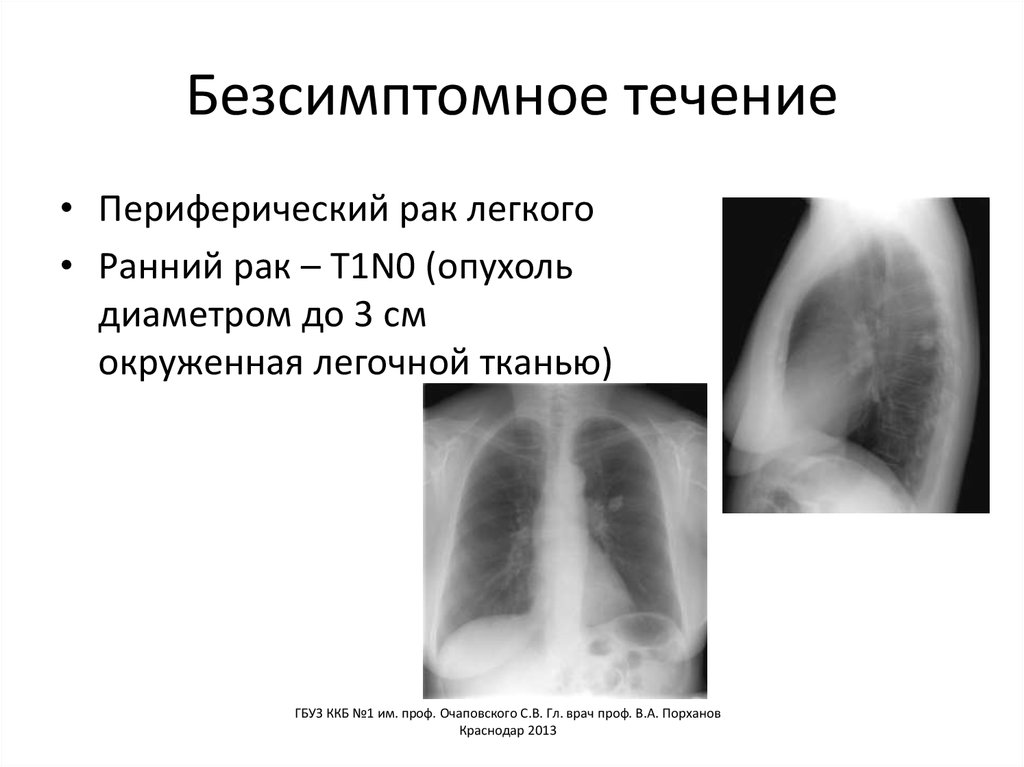 Безсимптомное течение