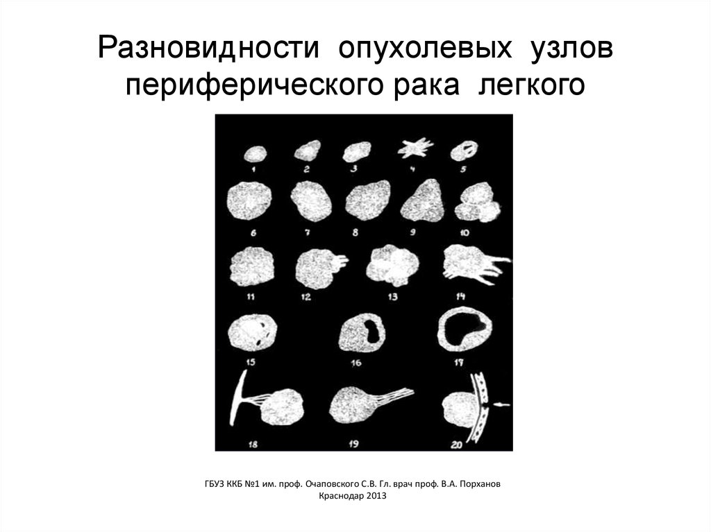 Разновидности опухолевых узлов периферического рака легкого