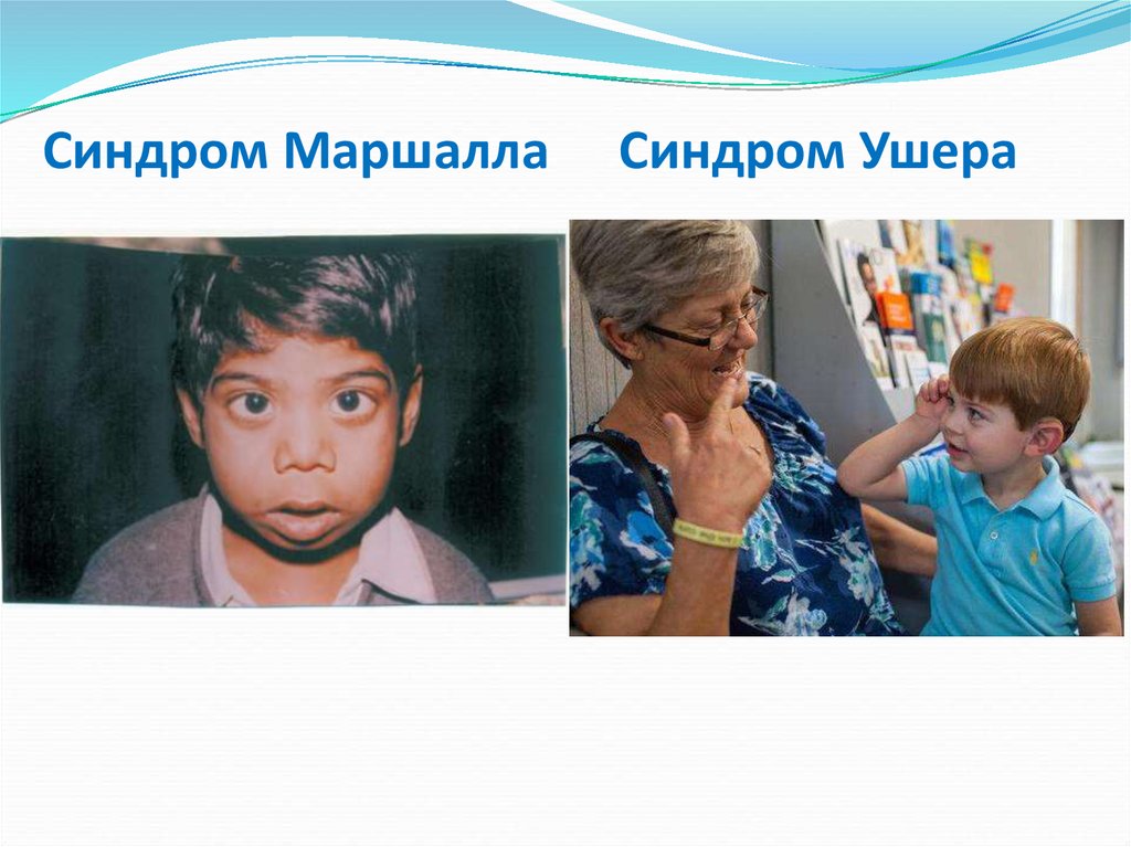 Синдром Маршалла