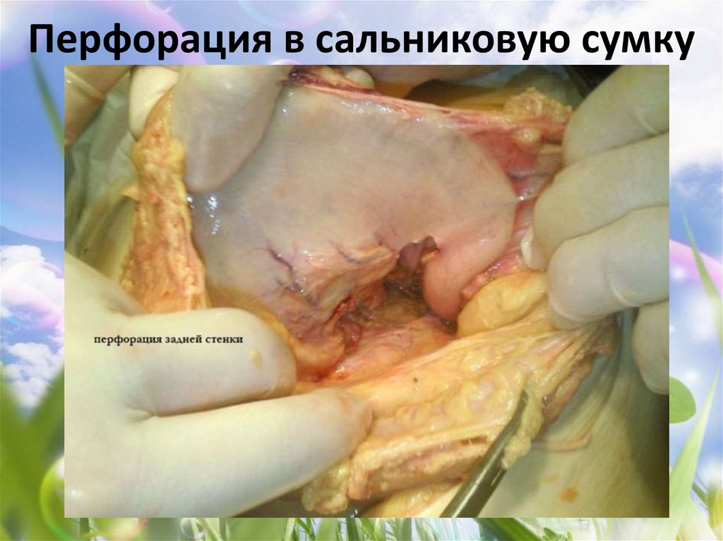Перфорация в сальниковую сумку