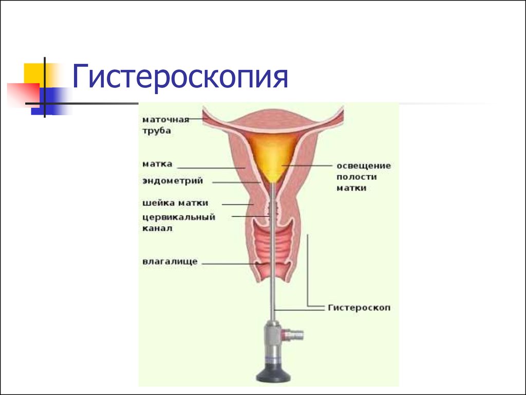 Диагностическое выскабливание матки и цервикального канала
