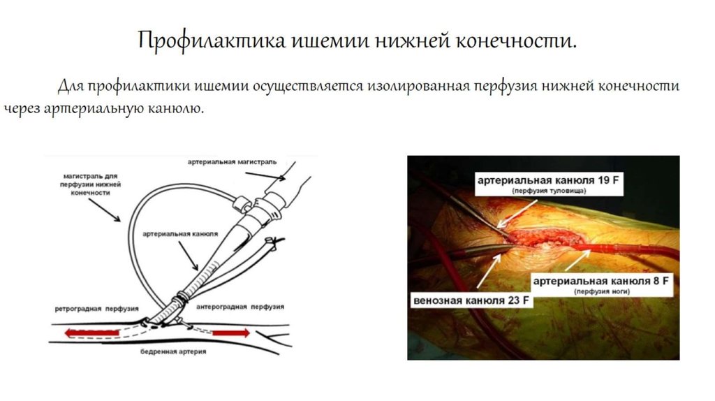 Профилактика ишемии нижней конечности.