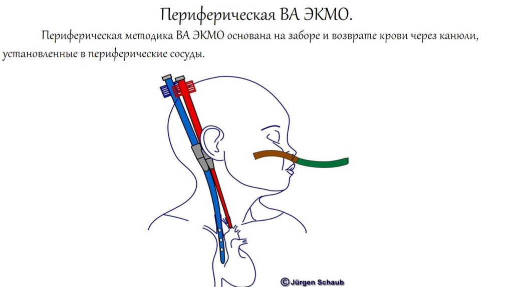 Периферическая ВА ЭКМО.