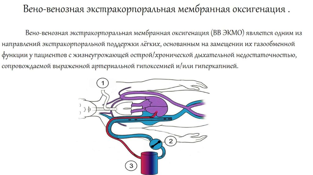 Вено-венозная экстракорпоральная мембранная оксигенация .