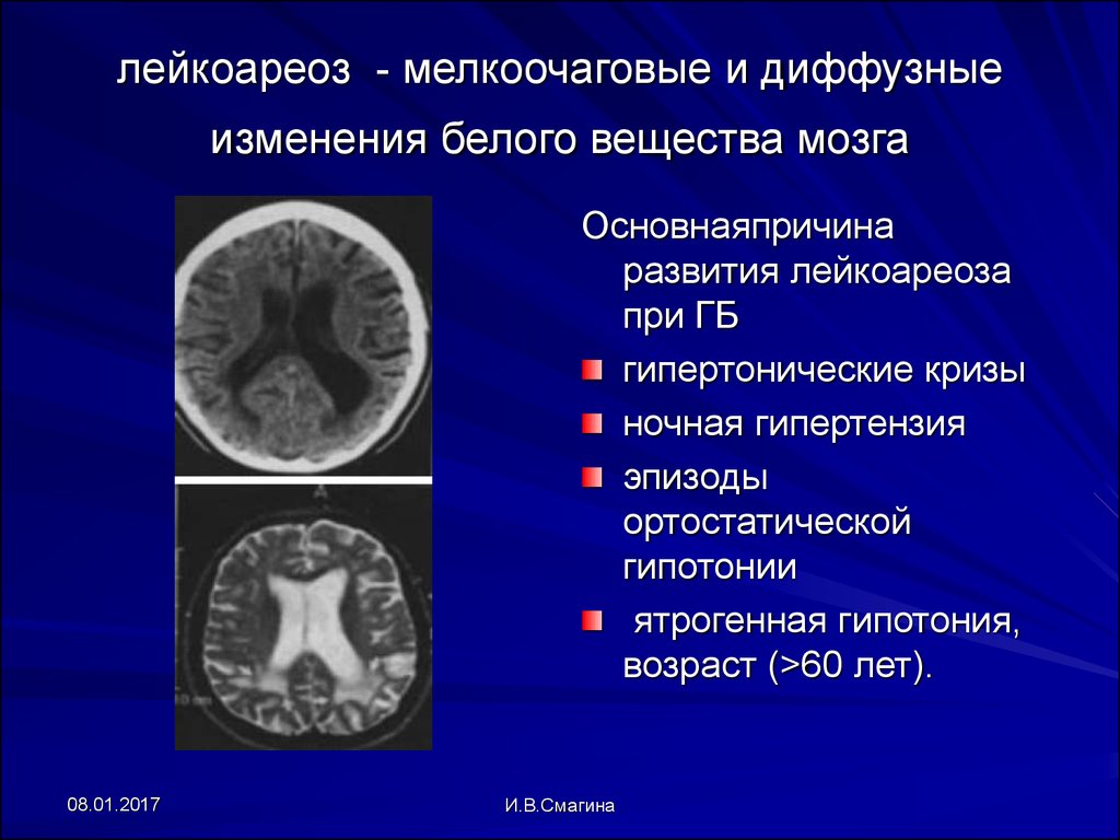 Резидуальные очаги головного мозга. Лейкоареоз RN. Лейкоарахиоз головного мозга. Перивентрикулярный лейкоареоз на кт. Лейкоареоз на кт.