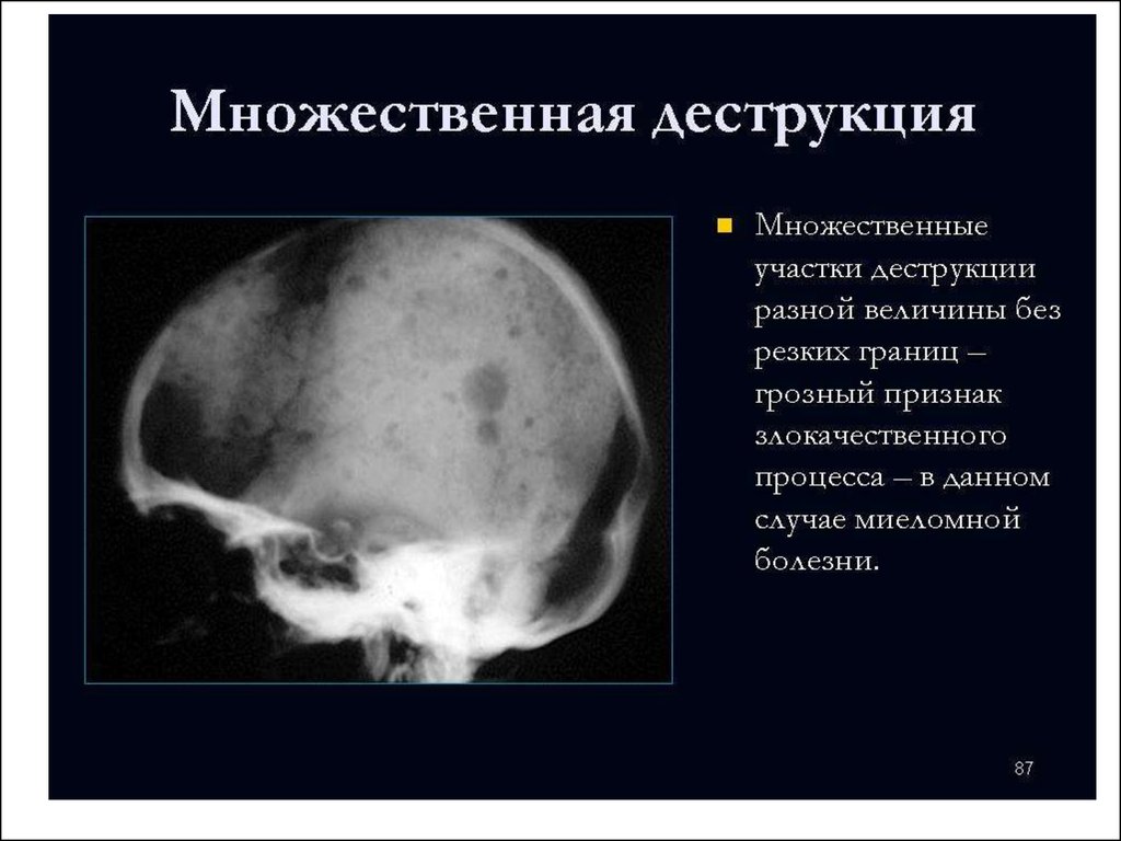 Множественные округлые. Миеломная болезнь рентген черепа. Миеломная болезнь рентген костей. Миеломная болезнь череп. Миеломная болезнь на кт черепа.