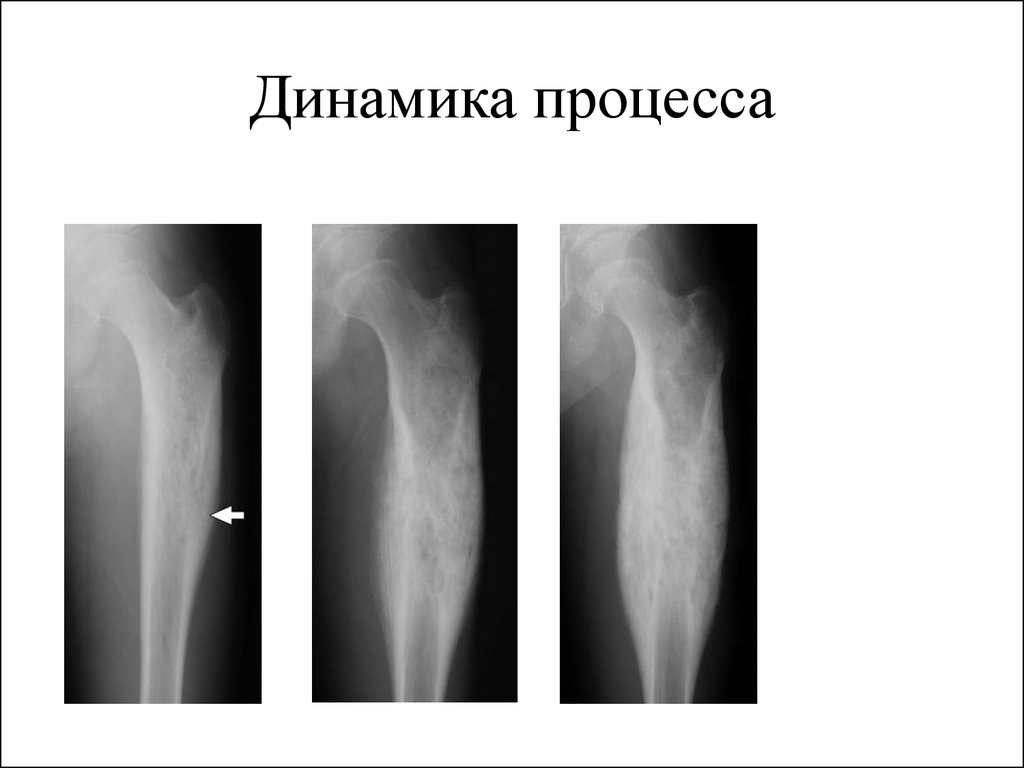 Огнестрельный остеомиелит. Остеомиелит Гарре рентген. Остеомиелит Гарре большеберцовой кости. Склерозирующий остеомиелит Гарре рентген.