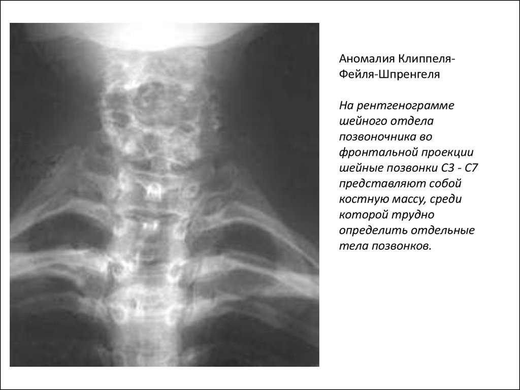 Шейный отдел позвоночника дети. Аномалия Клиппеля-Фейля. Аномалия Клиппеля-Фейля-Шпренгеля рентген. Синдром Клиппеля-Фейля рентген. Незаращение задней дужки Атланта рентген.