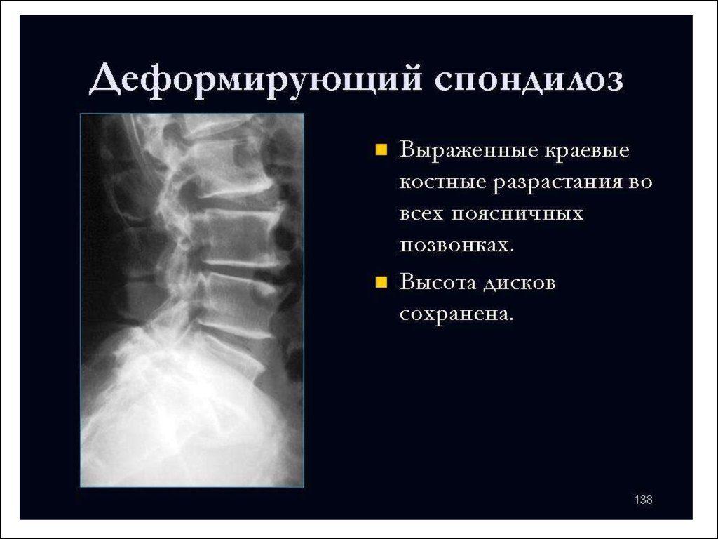 Склероз замыкательных пластинок. Замыкательные пластинки тел позвонков на рентген. Краевые костные разрастания замыкательных пластинок тел позвонков. Краевые костные разрастания. Краевые разрастания тел позвонков.